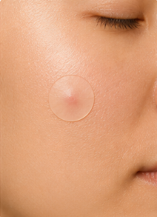 Glow Theory Spot Rescue™ | Hydrocolloid Spot Patches